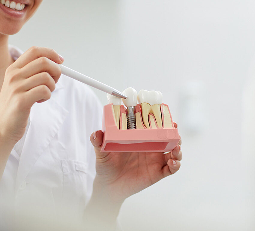 Implantes_dentales